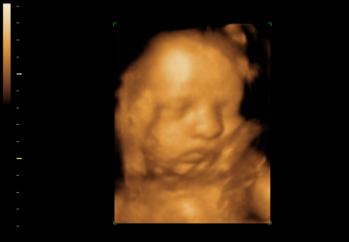 3D ultrasound image at 31 weeks